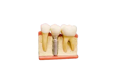 Implantes image Implantes image