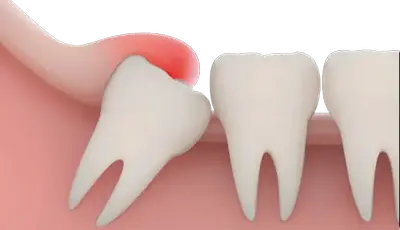 Wisdom tooth image Wisdom tooth image