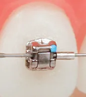 self ligating braces