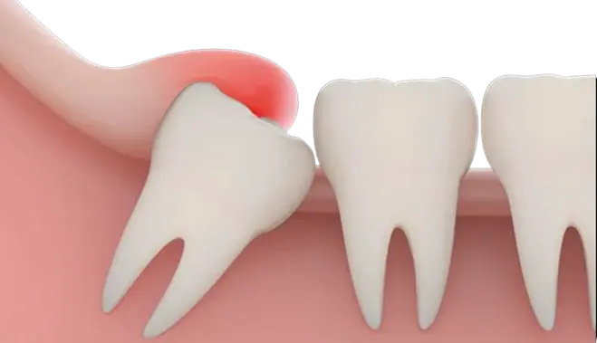 Wisdom tooth image